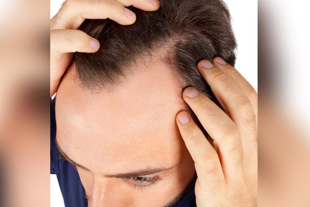 Hair loss in men