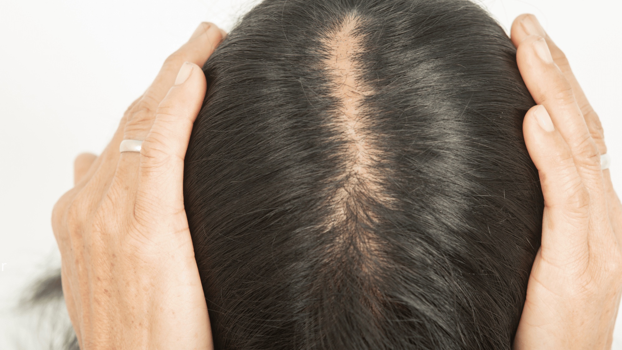 Unveiling the Early Signs of Hair Thinning: A Comprehensive Guide for Men and Women