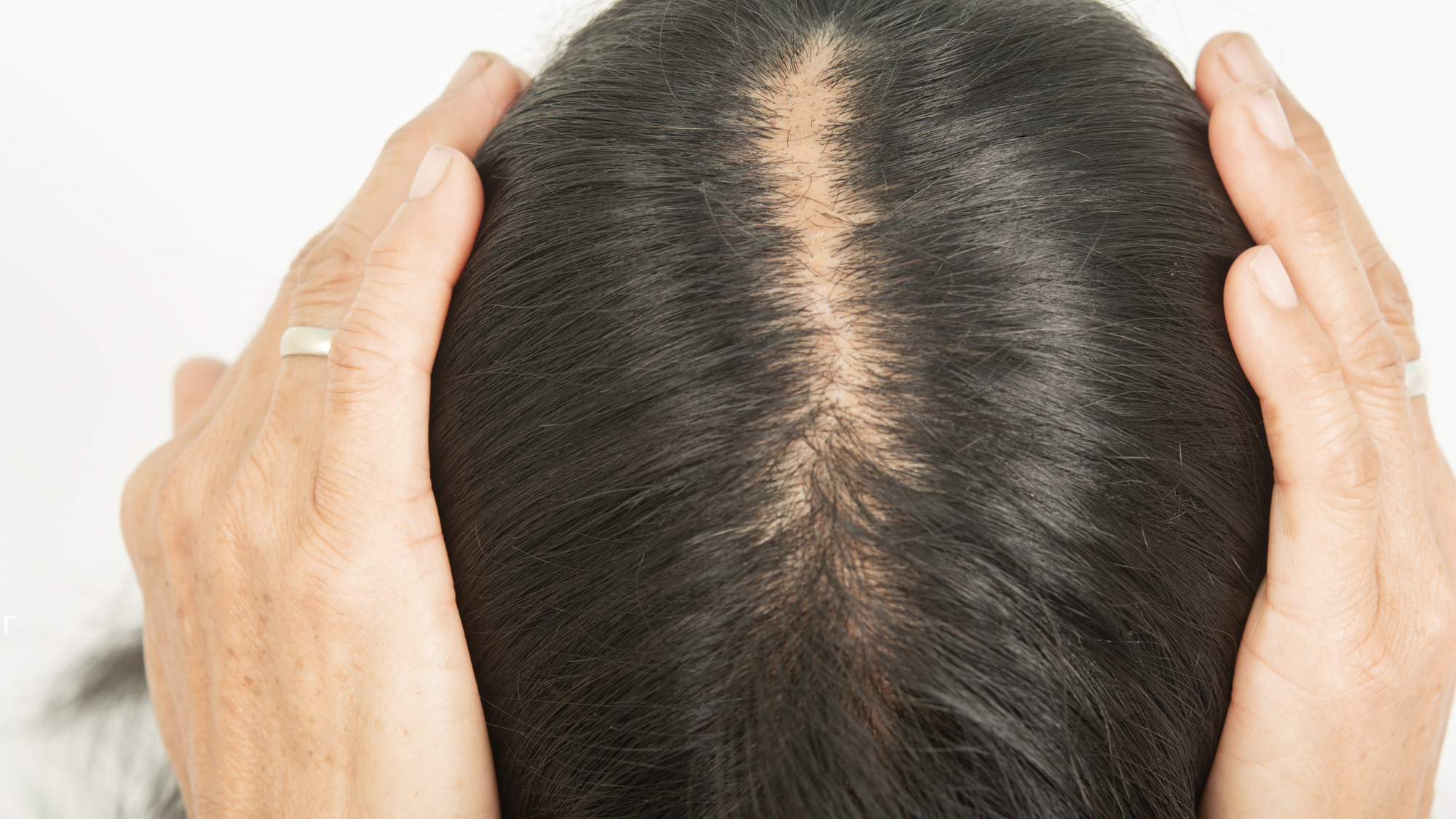 Unveiling the Early Signs of Hair Thinning: A Comprehensive Guide for Men and Women