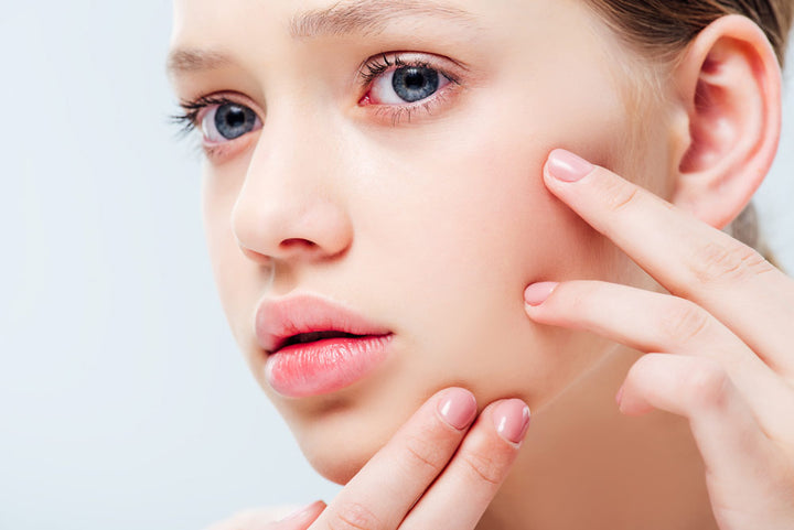 Common skin problems faced by teenagers